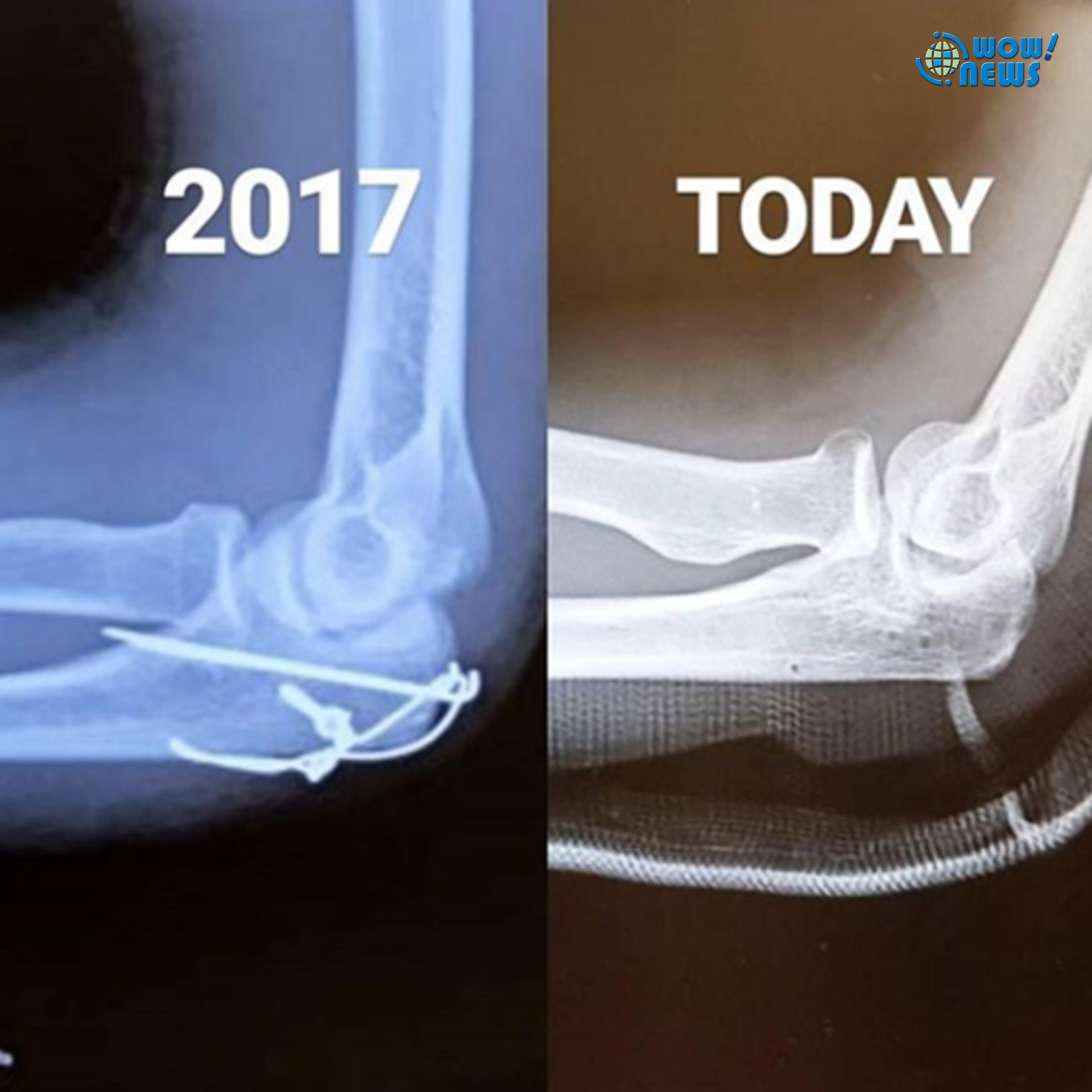 Jun K右臂骨折基本痊愈鋼釘已被取出life生活網 Jun K右臂骨折基本痊愈鋼釘已被取出life生活網